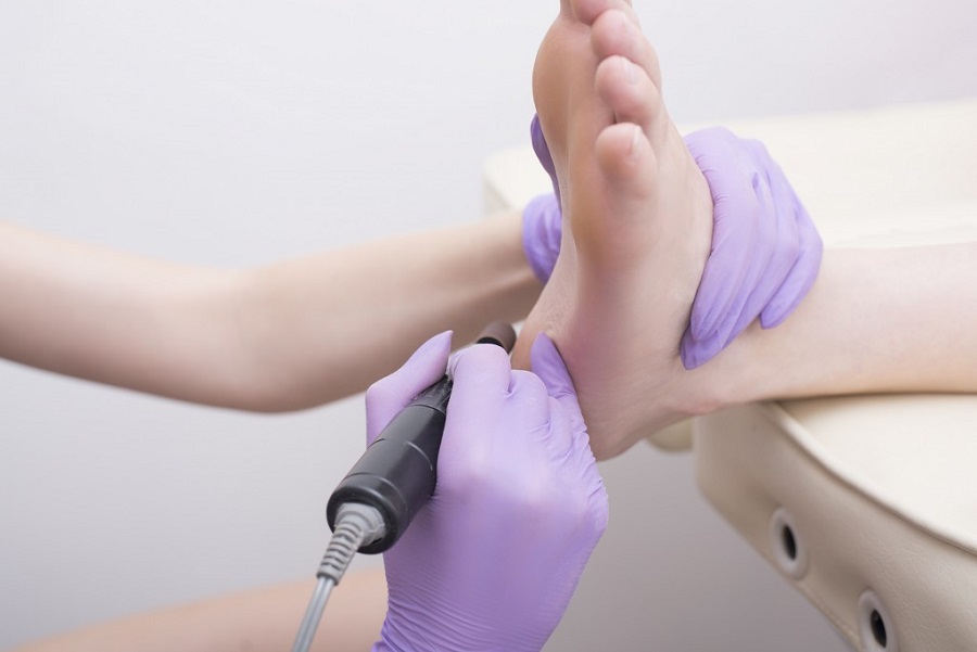 processo-di-trattamento-della-pelle-del-piede-mani-guantate-podologo