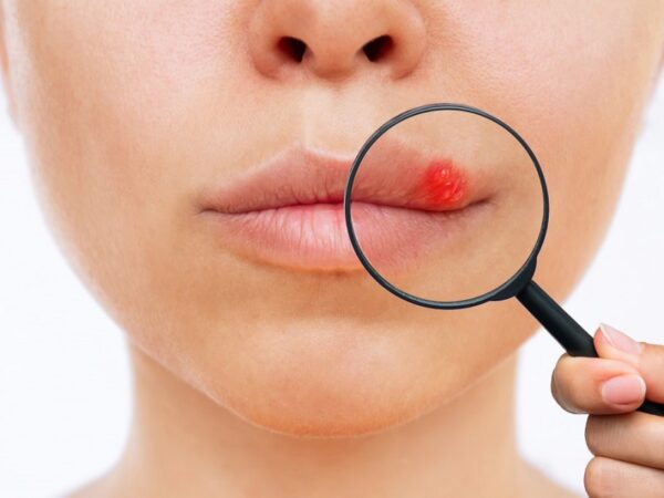 Herpes Labiale: cos’è e per quale motivo ricompare?